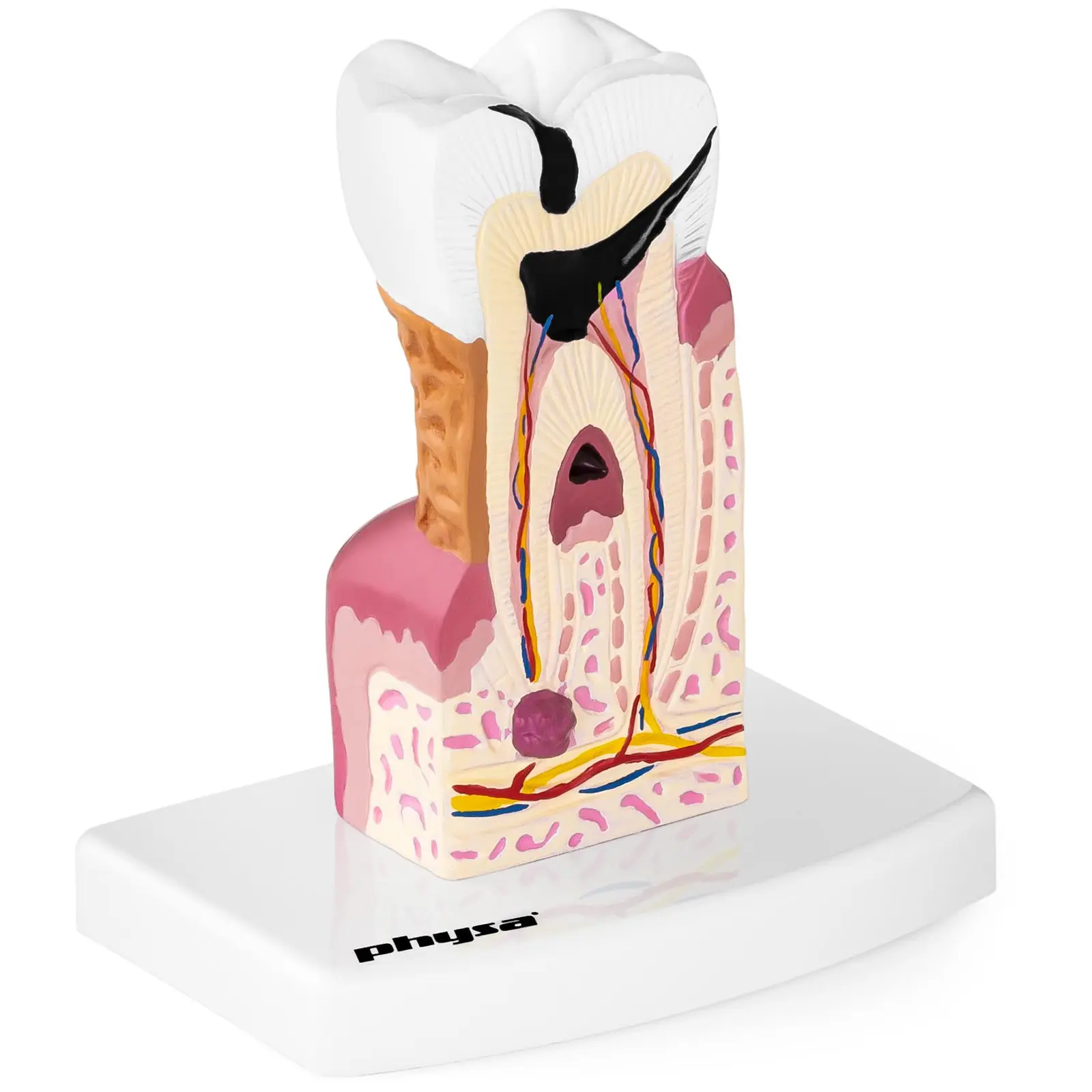 Tooth Model - Diseased Molar