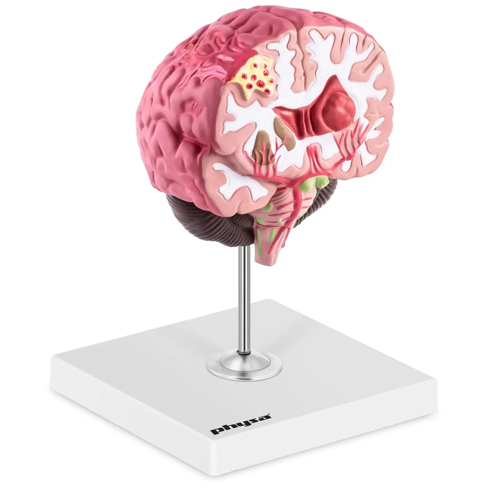 Brain Model - pathological - full-colour